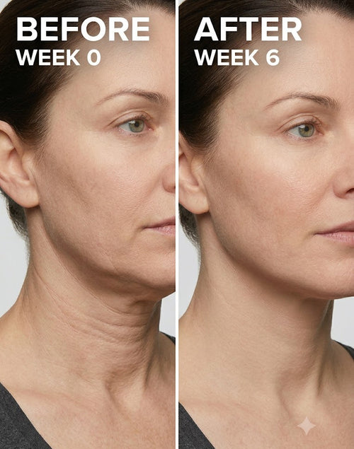 Before and after comparison of a woman's neck skin texture improvement over 6 weeks.